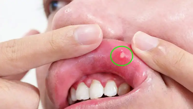 Dilinin Alınması Gereken Genç Kadın, Kanserin Ölümcül Uyarısını Göz Ardı Etti!