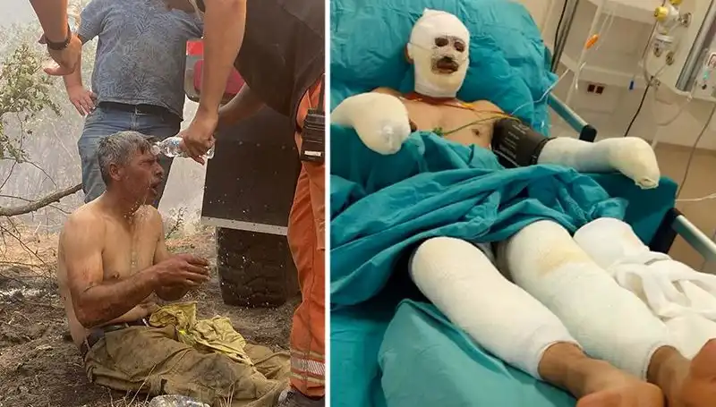 Yanıyorum Diye Feryat Eden Orman İşçisinin Tedavisi Devam Ediyor: Son Durum Ne?