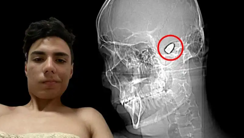 Kafasında Patlayıcı Olan Adam, Hayatıyla İlgili Şok Edici Gerçekleri Ortaya Çıkardı!